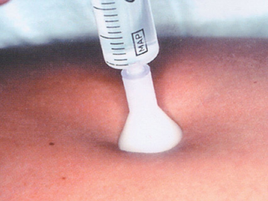 S.I.T. SKIN INJECTION THERAPY 31G 0,26X2.5 mm - white