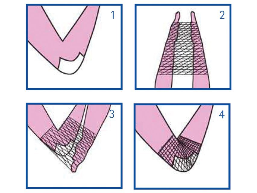 ELASTIC TUBULAR NETTING 3 for hand, elbow and arm